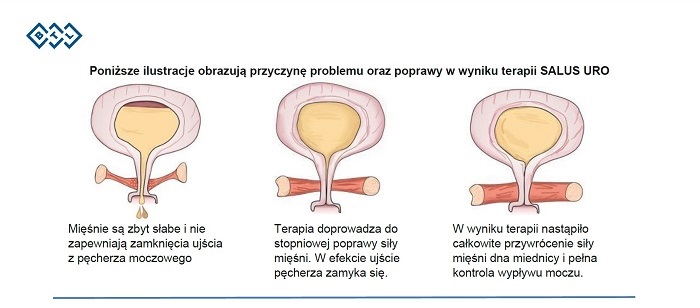 Rehabilitacja uroginekologiczna - SALUST-TALENT URO